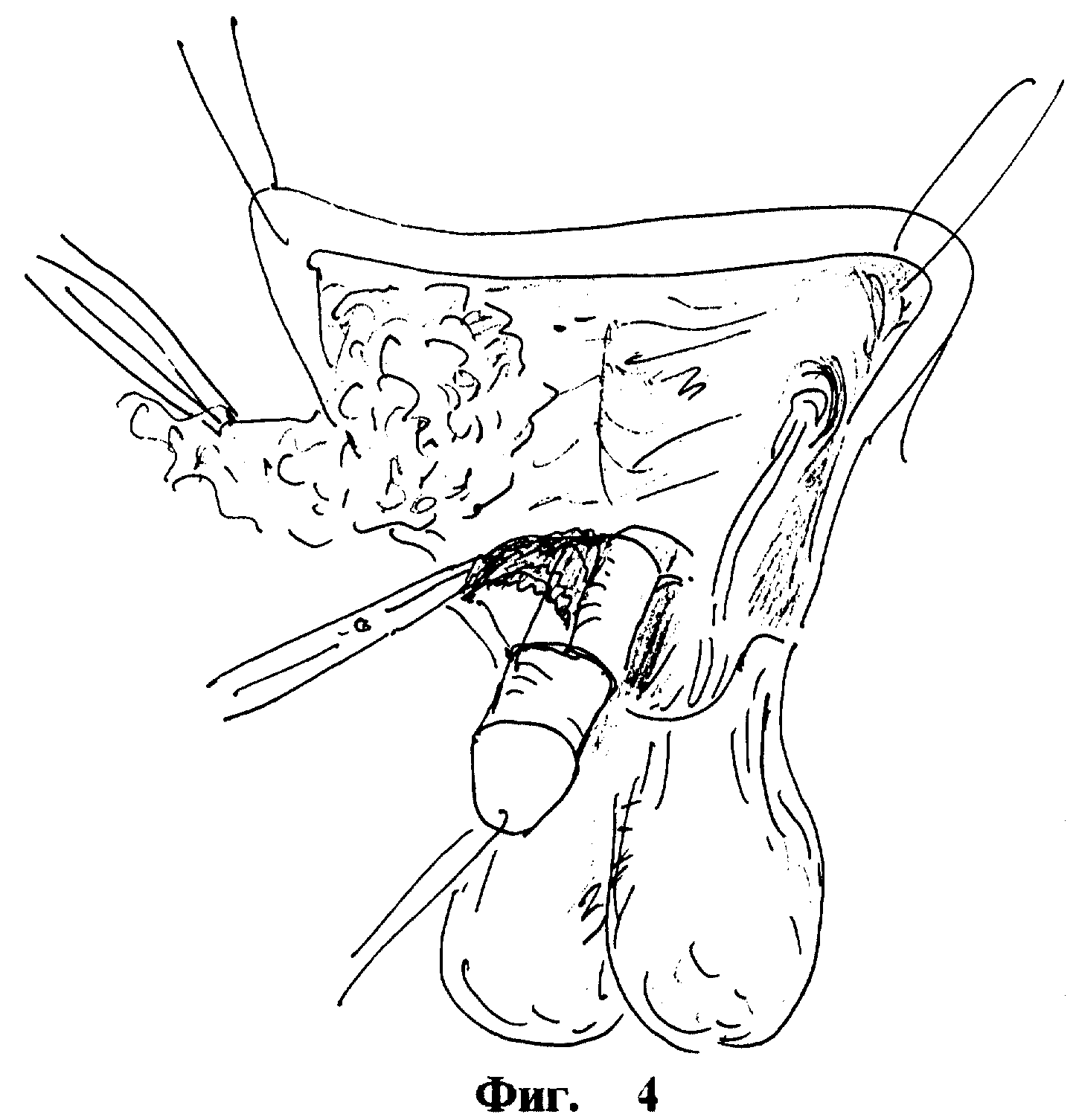 СПОСОБ ХИРУРГИЧЕСКОГО ЛЕЧЕНИЯ СКРЫТОГО ПОЛОВОГО ЧЛЕНА У МАЛЬЧИКОВ. Патент №  RU 2143851 МПК A61B17/00 | Биржа патентов - Московский инновационный кластер