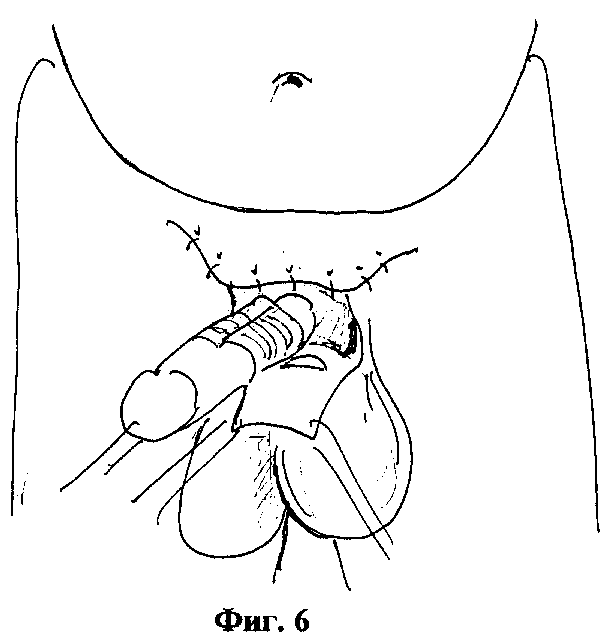 СПОСОБ ХИРУРГИЧЕСКОГО ЛЕЧЕНИЯ СКРЫТОГО ПОЛОВОГО ЧЛЕНА У МАЛЬЧИКОВ. Патент №  RU 2143851 МПК A61B17/00 | Биржа патентов - Московский инновационный кластер