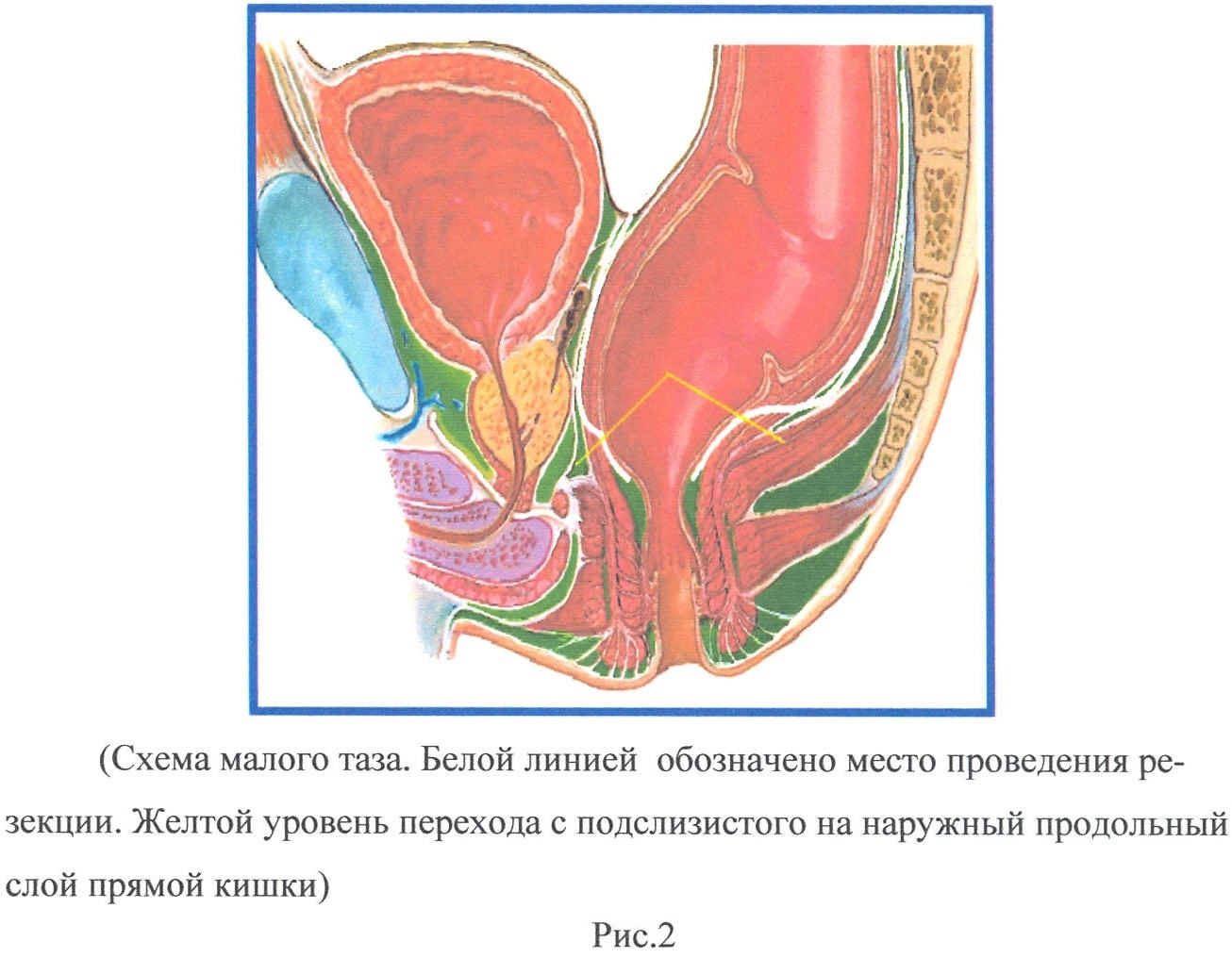 СПОСОБ ТРАНСАНАЛЬНОЙ РЕЗЕКЦИИ ПРЯМОЙ КИШКИ ПРИ БОЛЕЗНИ ГИРШПРУНГА У ДЕТЕЙ.  Патент № RU 2410046 МПК A61B17/11 | Биржа патентов - Московский  инновационный кластер