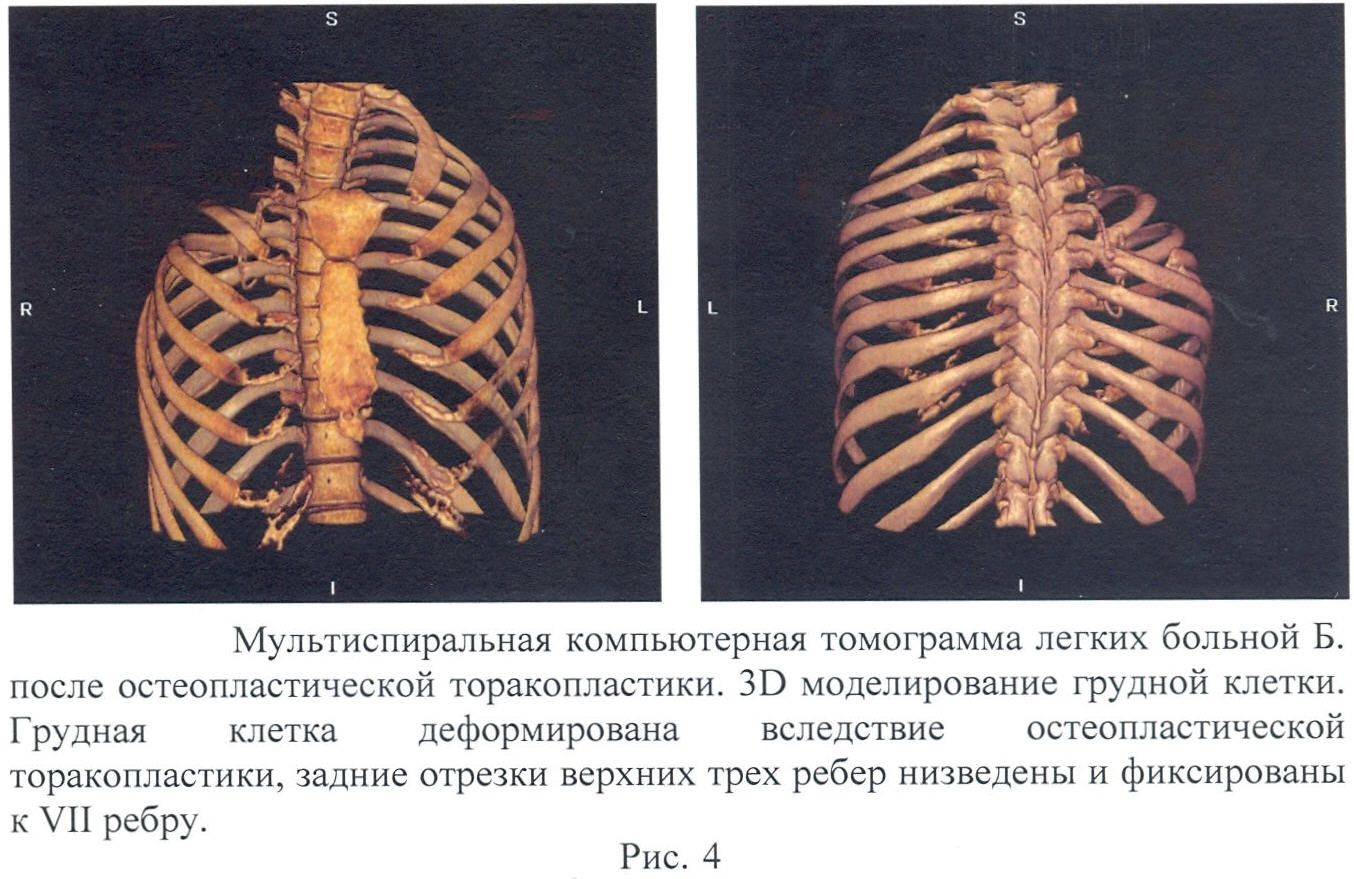 СПОСОБ ЛЕЧЕНИЯ ДЕСТРУКТИВНОГО ТУБЕРКУЛЕЗА ЛЕГКИХ. Патент № RU 2475192 МПК  A61B17/00 | Биржа патентов - Московский инновационный кластер