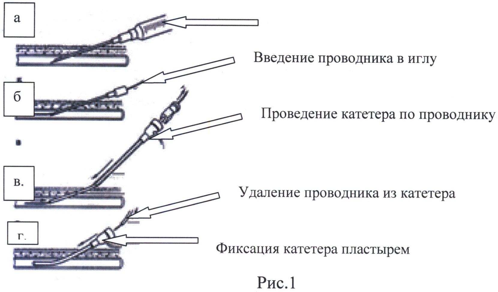 СПОСОБ КАТЕТЕРИЗАЦИИ ЦЕНТРАЛЬНЫХ ВЕН У ДЕТЕЙ. Патент № RU 2527163 МПК  A61M25/00 | Биржа патентов - Московский инновационный кластер