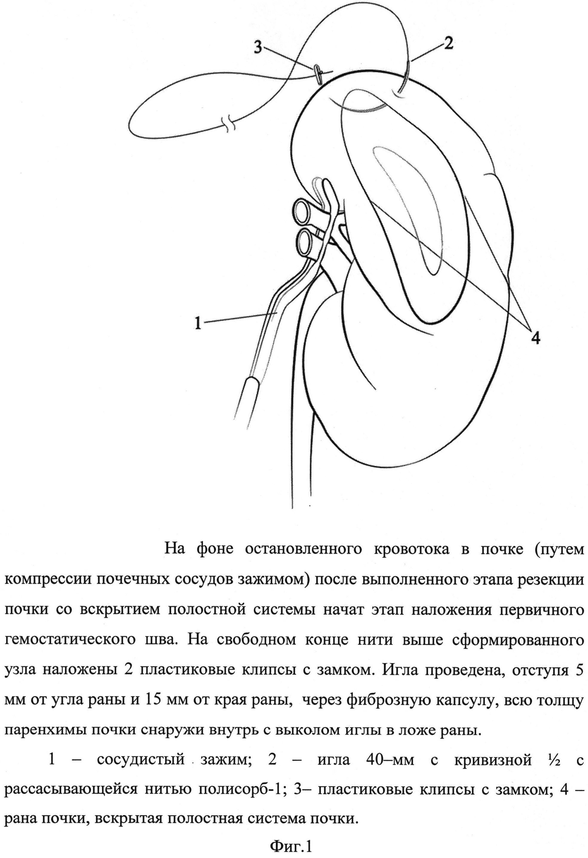 СПОСОБ УШИВАНИЯ РАНЫ ПОЧКИ ПРИ ЛАПАРОСКОПИЧЕСКОМ ОРГАНОСОХРАНЯЮЩЕМ ЛЕЧЕНИИ  РАКА ПОЧКИ В УСЛОВИЯХ ТЕПЛОВОЙ ИШЕМИИ. Патент № RU 2532897 МПК A61B17/00 |  Биржа патентов - Московский инновационный кластер