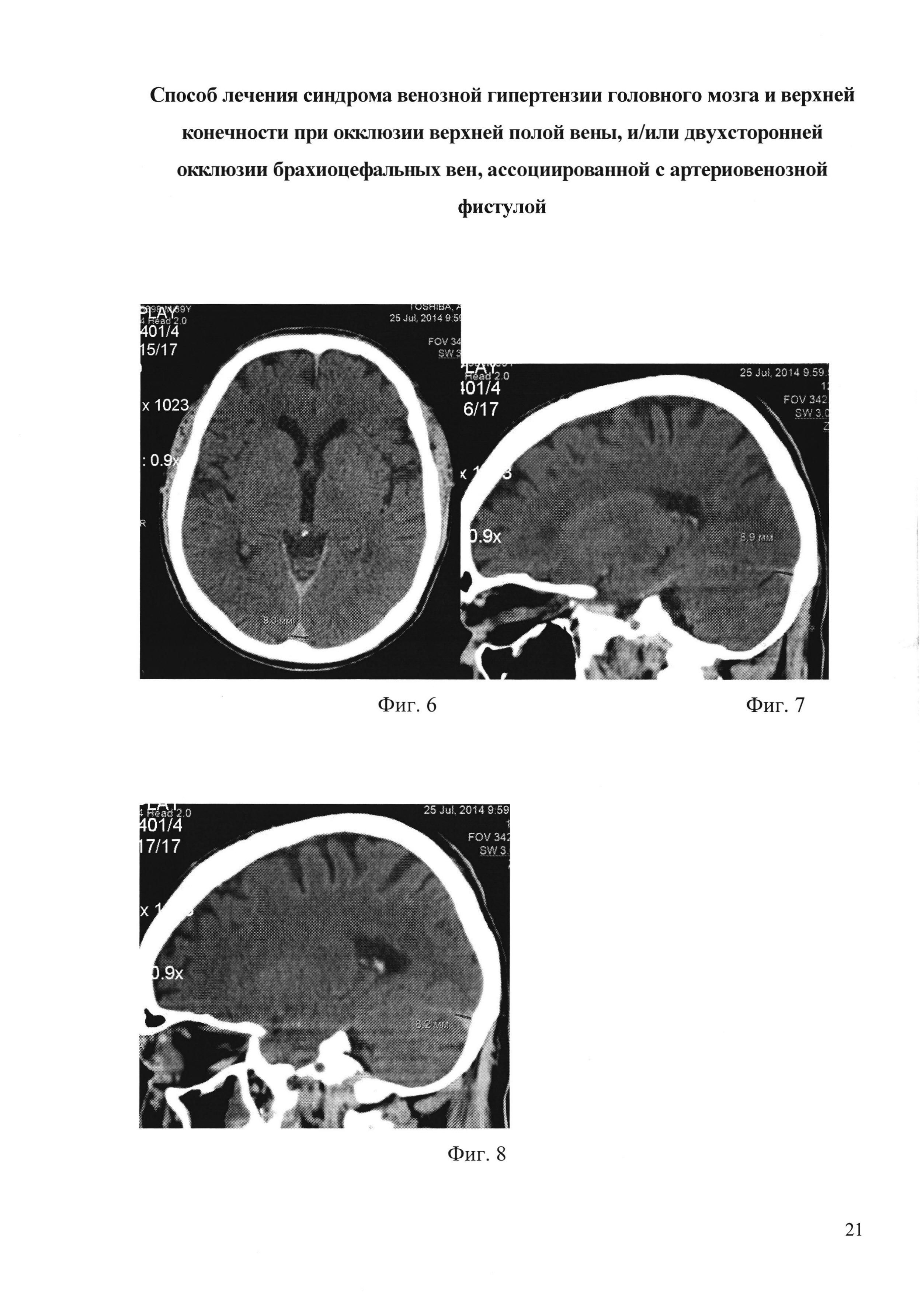 СПОСОБ ЛЕЧЕНИЯ СИНДРОМА ВЕНОЗНОЙ ГИПЕРТЕНЗИИ ГОЛОВНОГО МОЗГА И ВЕРХНЕЙ  КОНЕЧНОСТИ ПРИ ОККЛЮЗИИ ВЕРХНЕЙ ПОЛОЙ ВЕНЫ И/ИЛИ ДВУСТОРОННЕЙ ОККЛЮЗИИ  БРАХИОЦЕФАЛЬНЫХ ВЕН, АССОЦИИРОВАННОЙ С АРТЕРИОВЕНОЗНОЙ ФИСТУЛОЙ. Патент №  RU 2573802 МПК A61B17/00 | Биржа