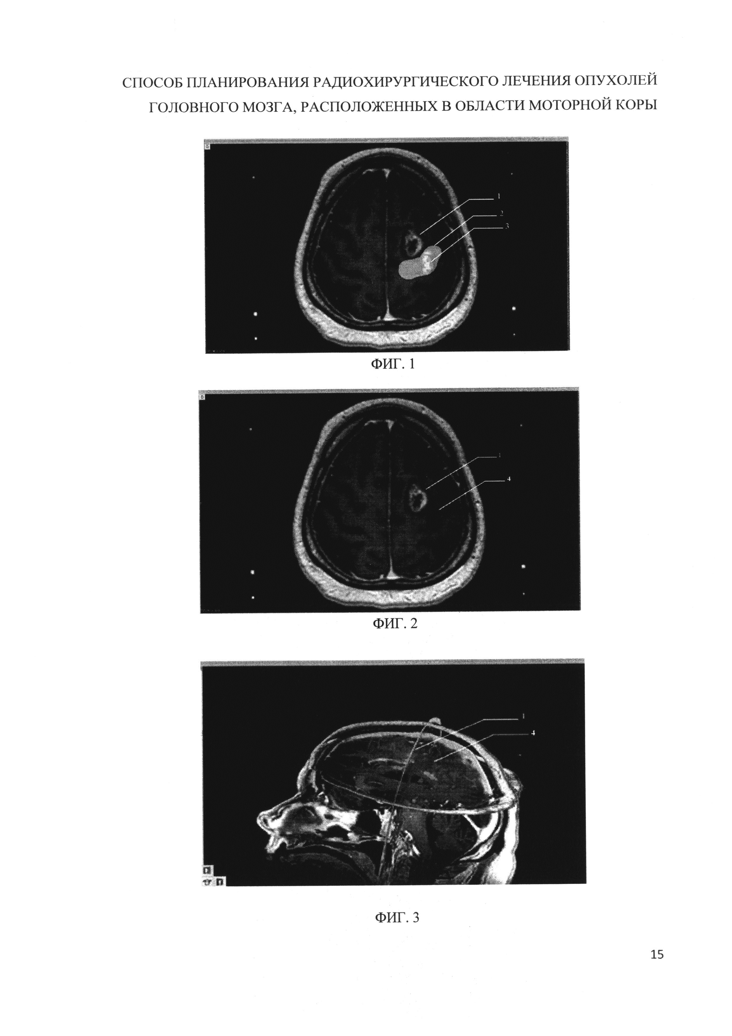 СПОСОБ ПЛАНИРОВАНИЯ РАДИОХИРУРГИЧЕСКОГО ЛЕЧЕНИЯ ОПУХОЛЕЙ ГОЛОВНОГО МОЗГА,  РАСПОЛОЖЕННЫХ В ОБЛАСТИ МОТОРНОЙ КОРЫ И/ИЛИ ПРИЛЕГАЮЩИХ К ДАННОЙ ОБЛАСТИ.  Патент № RU 2655880 МПК A61B8/13 | Биржа патентов - Московский  инновационный кластер