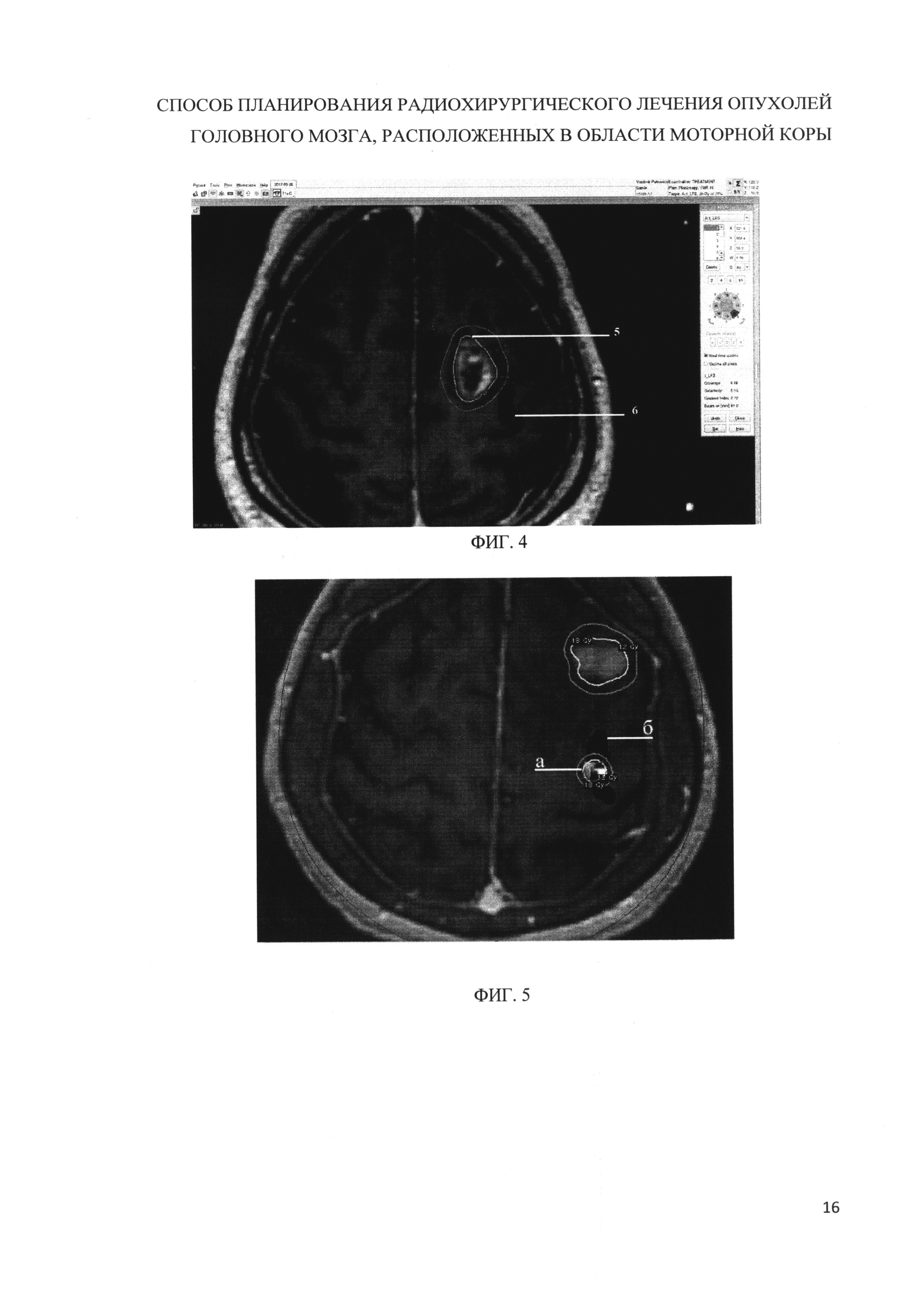 СПОСОБ ПЛАНИРОВАНИЯ РАДИОХИРУРГИЧЕСКОГО ЛЕЧЕНИЯ ОПУХОЛЕЙ ГОЛОВНОГО МОЗГА,  РАСПОЛОЖЕННЫХ В ОБЛАСТИ МОТОРНОЙ КОРЫ И/ИЛИ ПРИЛЕГАЮЩИХ К ДАННОЙ ОБЛАСТИ.  Патент № RU 2655880 МПК A61B8/13 | Биржа патентов - Московский  инновационный кластер