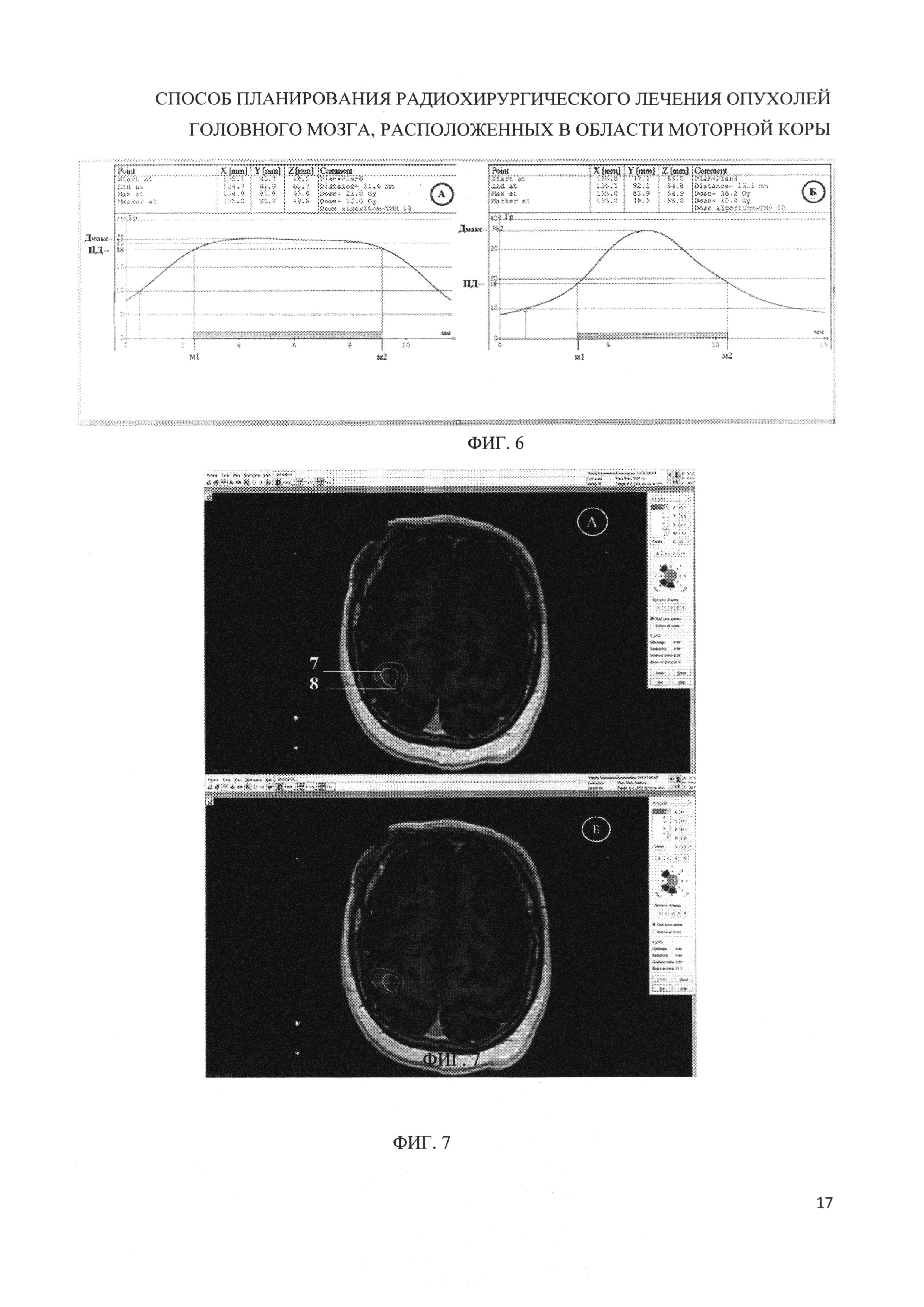 СПОСОБ ПЛАНИРОВАНИЯ РАДИОХИРУРГИЧЕСКОГО ЛЕЧЕНИЯ ОПУХОЛЕЙ ГОЛОВНОГО МОЗГА,  РАСПОЛОЖЕННЫХ В ОБЛАСТИ МОТОРНОЙ КОРЫ И/ИЛИ ПРИЛЕГАЮЩИХ К ДАННОЙ ОБЛАСТИ.  Патент № RU 2655880 МПК A61B8/13 | Биржа патентов - Московский  инновационный кластер