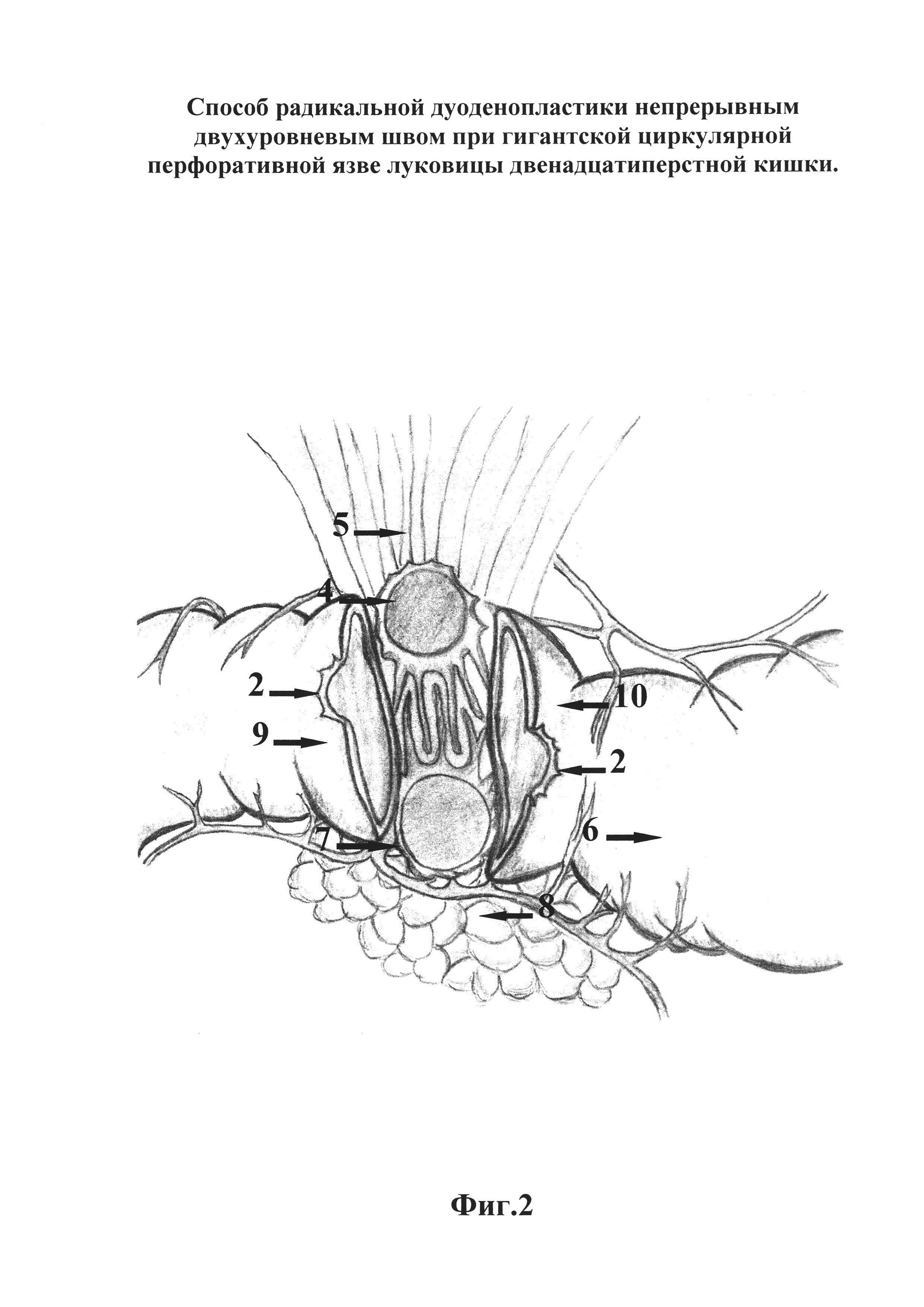 Способ радикальной дуоденопластики непрерывным двухуровневым швом при  гигантской циркулярной перфоративной язве луковицы двенадцатиперстной кишки.  Патент № RU 2664176 МПК A61B17/11 | Биржа патентов - Московский  инновационный кластер