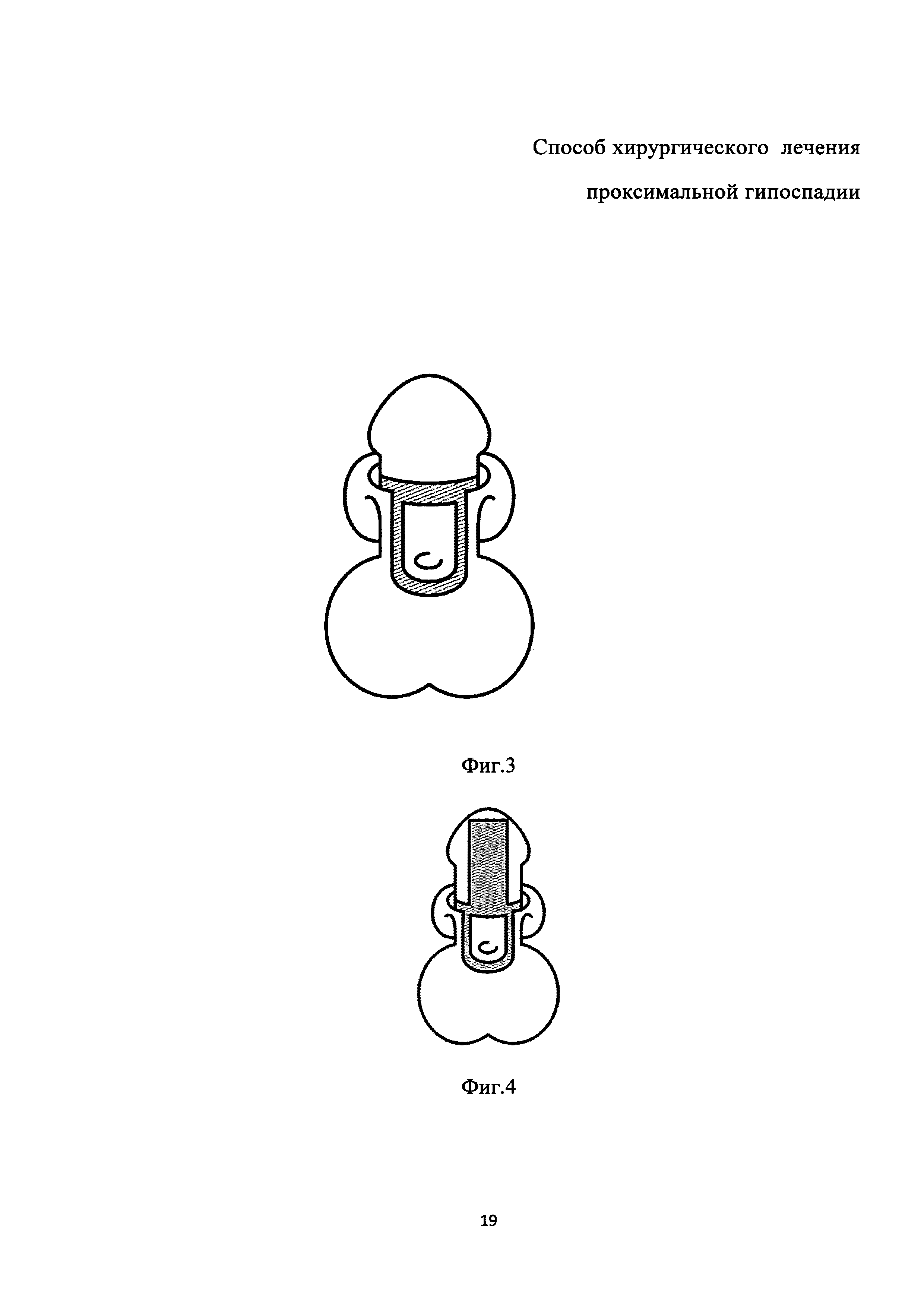 СПОСОБ ХИРУРГИЧЕСКОГО ЛЕЧЕНИЯ ПРОКСИМАЛЬНОЙ ГИПОСПАДИИ. Патент № RU 2665545  МПК A61B17/00 | Биржа патентов - Московский инновационный кластер