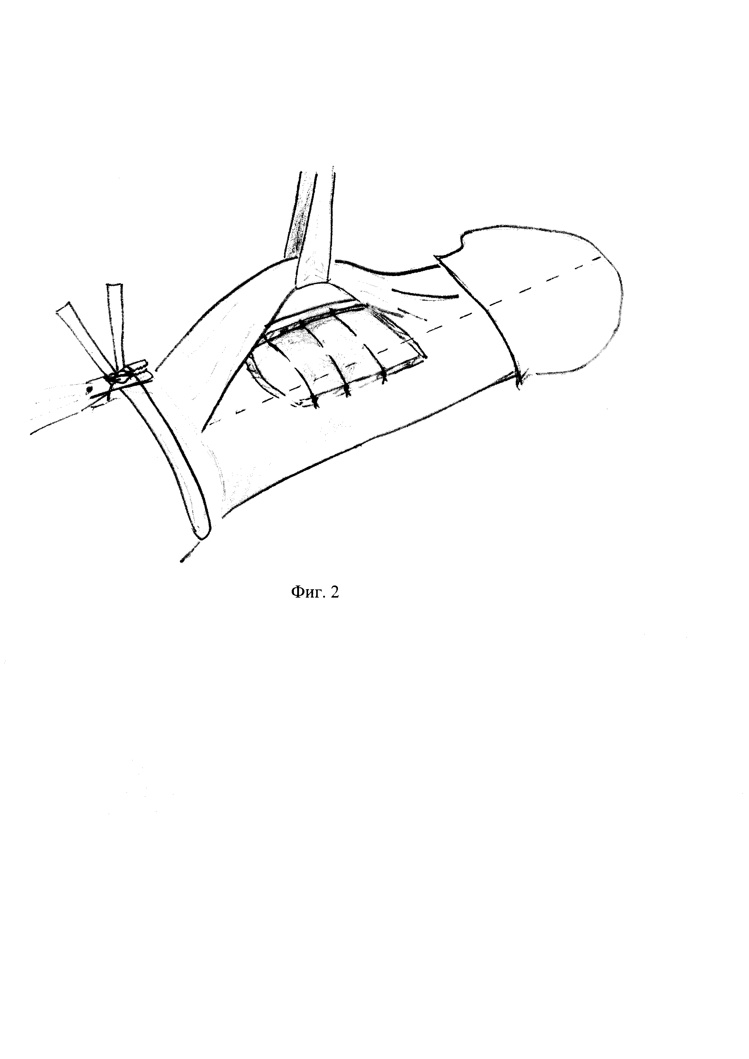 Способ хирургического лечения болезни Пейрони, осложненной искривлением полового  члена. Патент № RU 2701575 МПК A61B17/00 | Биржа патентов - Московский  инновационный кластер