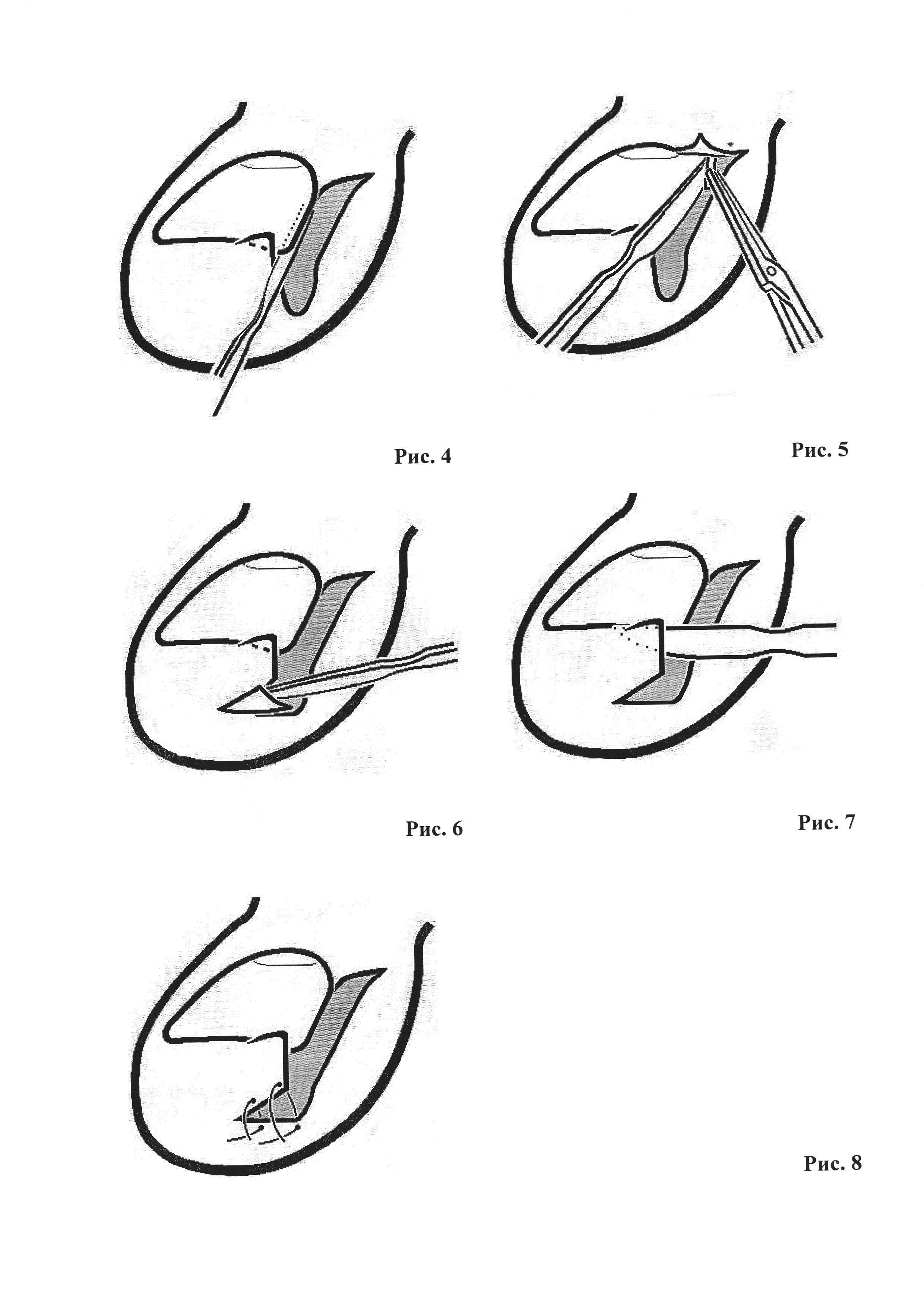 Хирургическое лечение вросшего ногтя