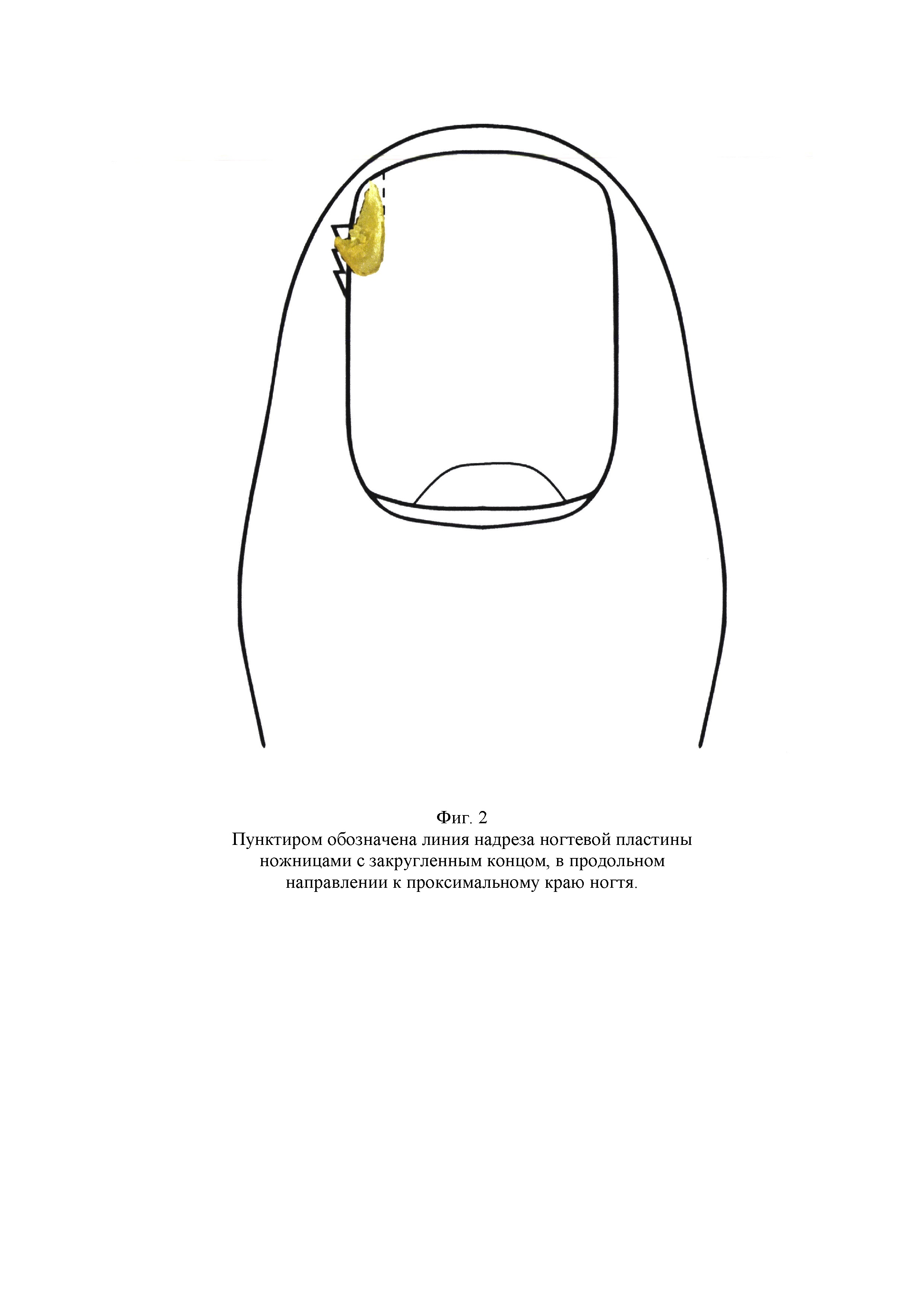 СПОСОБ ОПЕРАТИВНОГО ЛЕЧЕНИЯ ВРОСШЕГО НОГТЯ. Патент № RU 2761411 МПК  A61B17/00 | Биржа патентов - Московский инновационный кластер