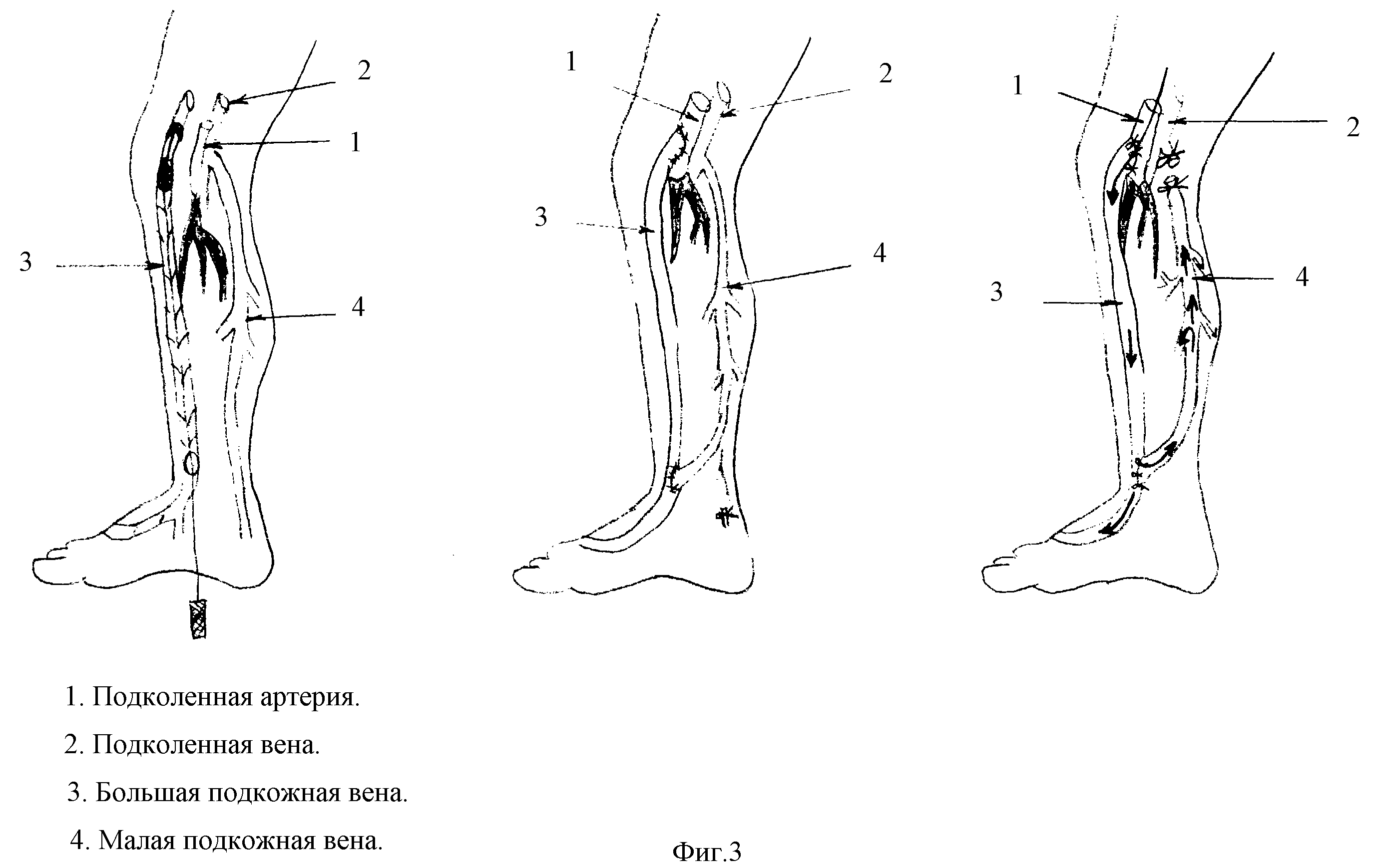 СПОСОБ ЛЕЧЕНИЯ КРИТИЧЕСКОЙ ИШЕМИИ НИЖНИХ КОНЕЧНОСТЕЙ. Патент № RU 2201145  МПК A61B17/11 | Биржа патентов - Московский инновационный кластер