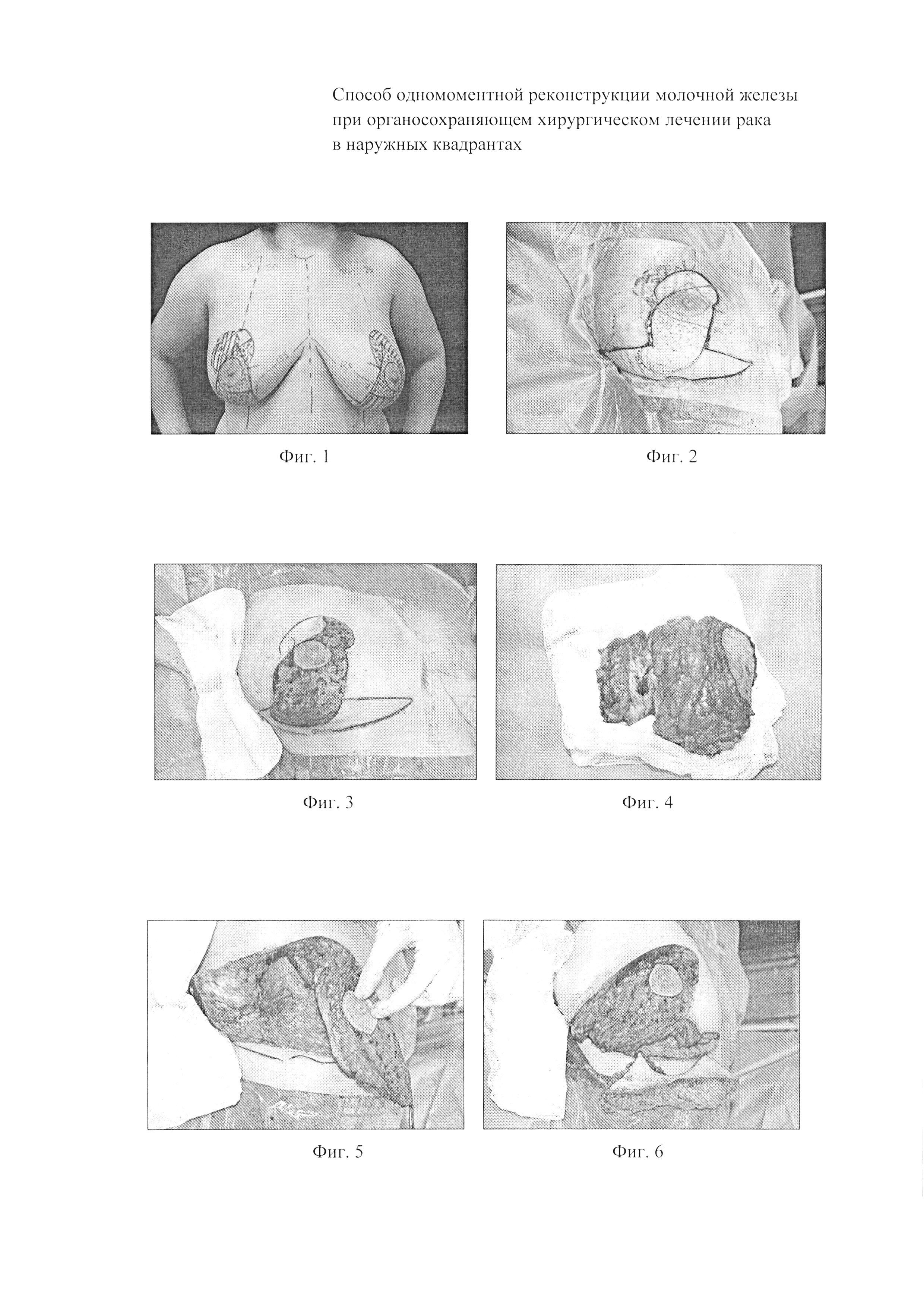 СПОСОБ ОДНОМОМЕНТНОЙ РЕКОНСТРУКЦИИ МОЛОЧНОЙ ЖЕЛЕЗЫ ПРИ ОРГАНОСОХРАНЯЮЩЕМ  ХИРУРГИЧЕСКОМ ЛЕЧЕНИИ РАКА В НАРУЖНЫХ КВАДРАНТАХ. Патент № RU 2597143 МПК  A61B17/00 | Биржа патентов - Московский инновационный кластер