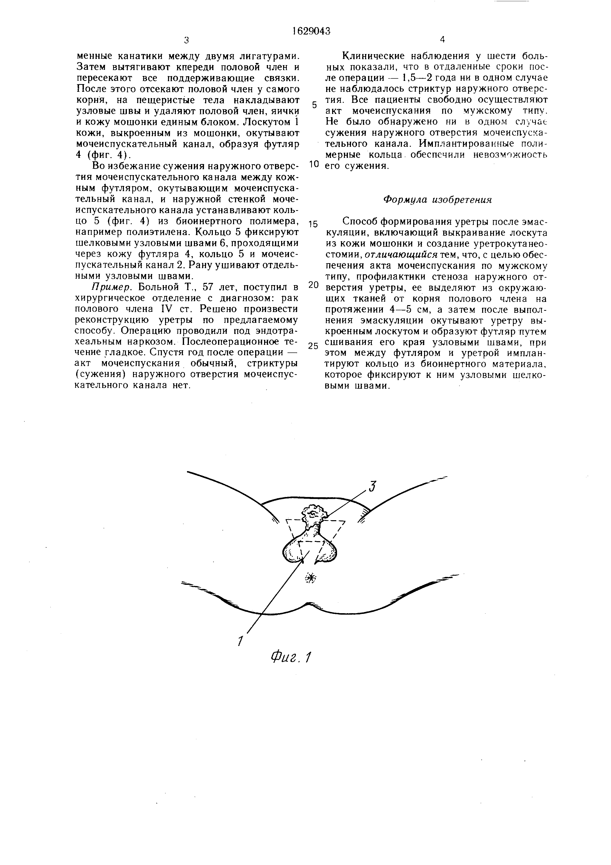 Способ формирования уретры после эмаскуляции. Патент № SU 1629043 МПК A61B17/00 | Биржа патентов - Московский инновационный кластер